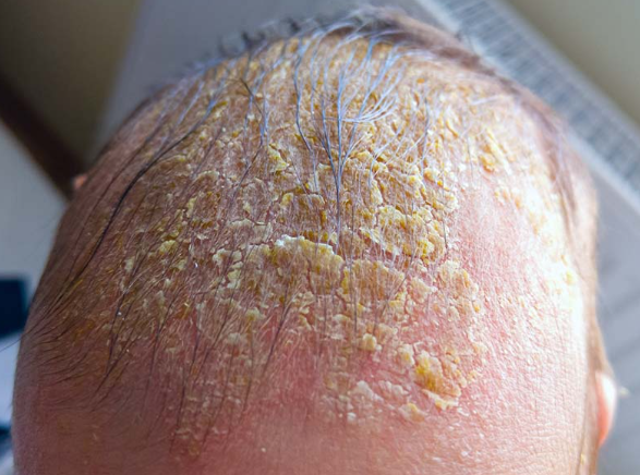 Homeopathy for Cradle Cap