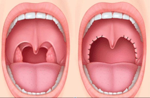 Tonsillectomy: Doubtful effectiveness? Homeopathy Role in Recurrent Tonsillitis 